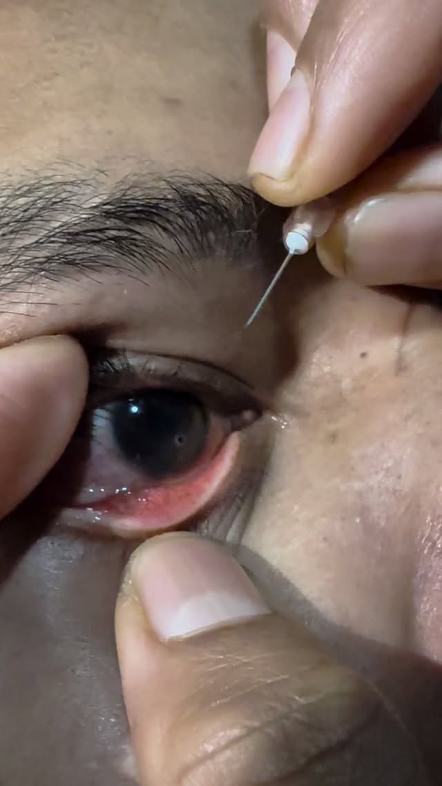 #thankyouforyoursupport #higlightsシ゚ #viralvideoシfyp #OphthalmicAssistant #facebookreel #intsagramre…