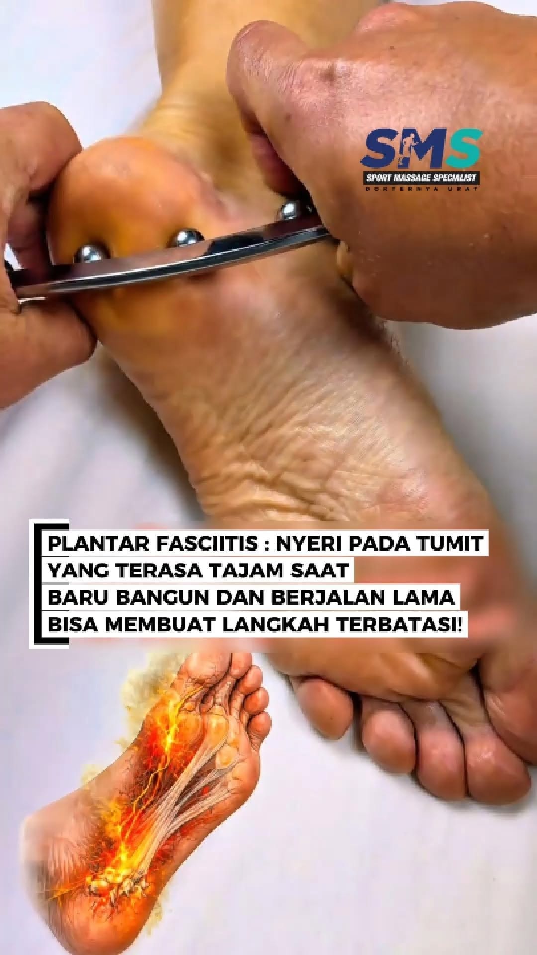 Banyak orang merasakan nyeri di tumit tapi sering dianggap sepele. Padahal dampaknya pada kaki bisa …