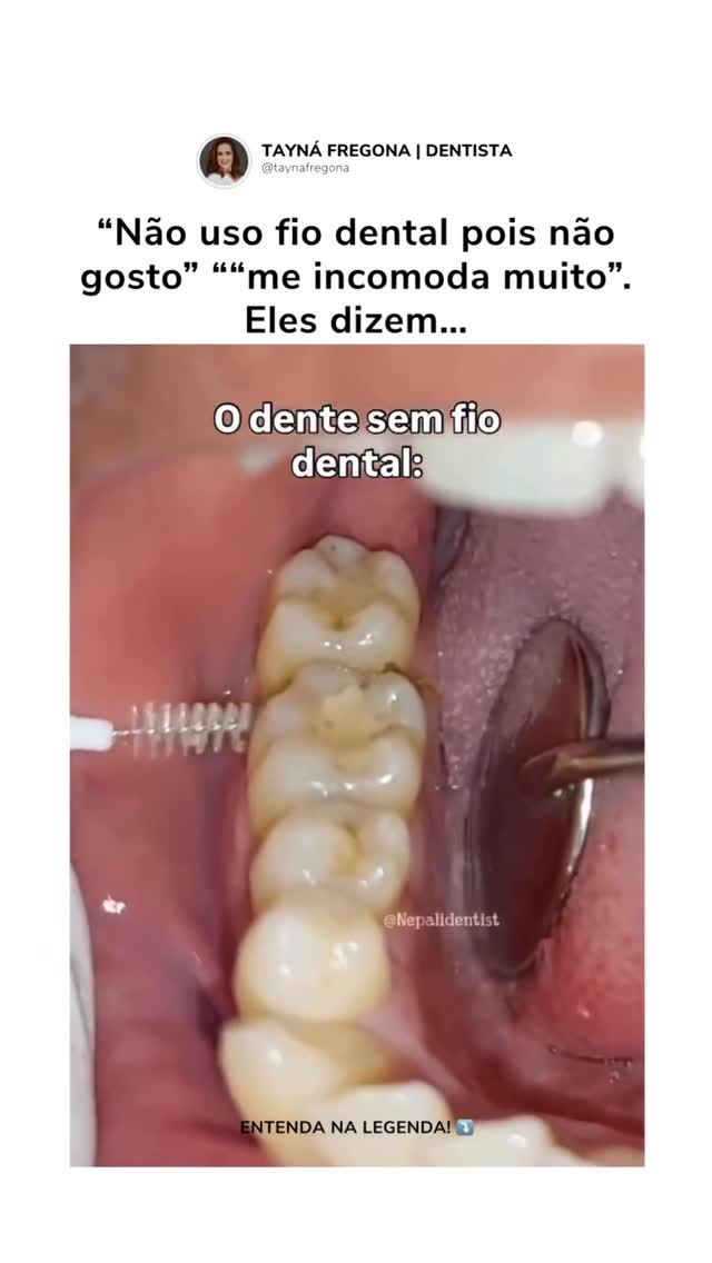 Você escova os dentes todos os dias… mas usa fio dental? Muita gente acha que só a escova já resolve…