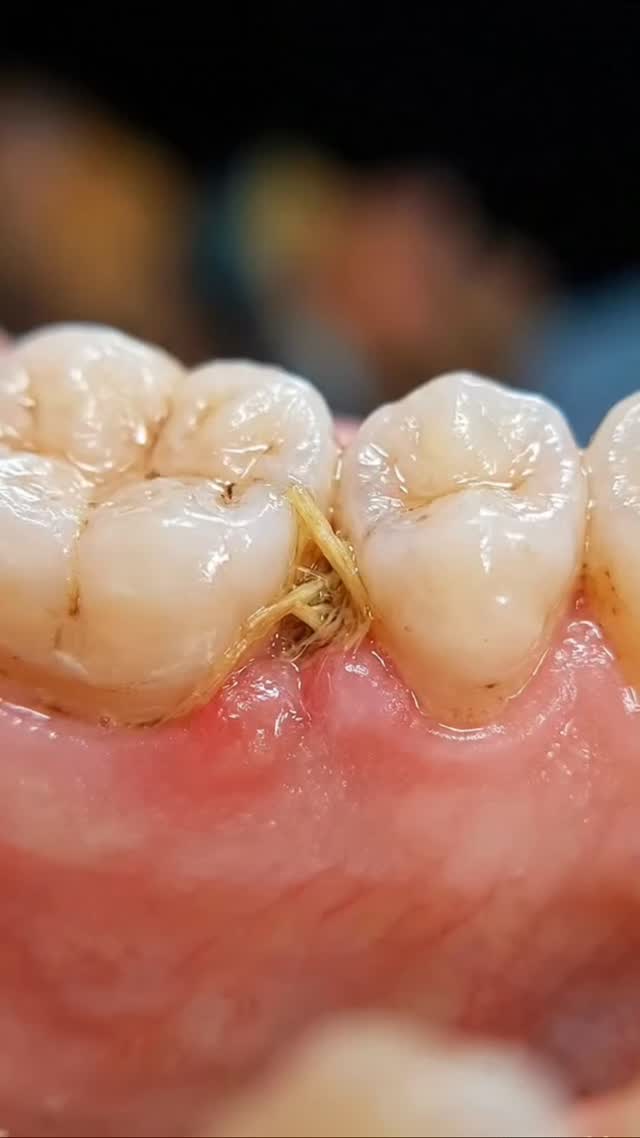 Stuck Food Pulled Out 😳 So Satisfying Clean #DentalASMR #DeepCleaning #ToothCleaning #OddlySatisfyin…