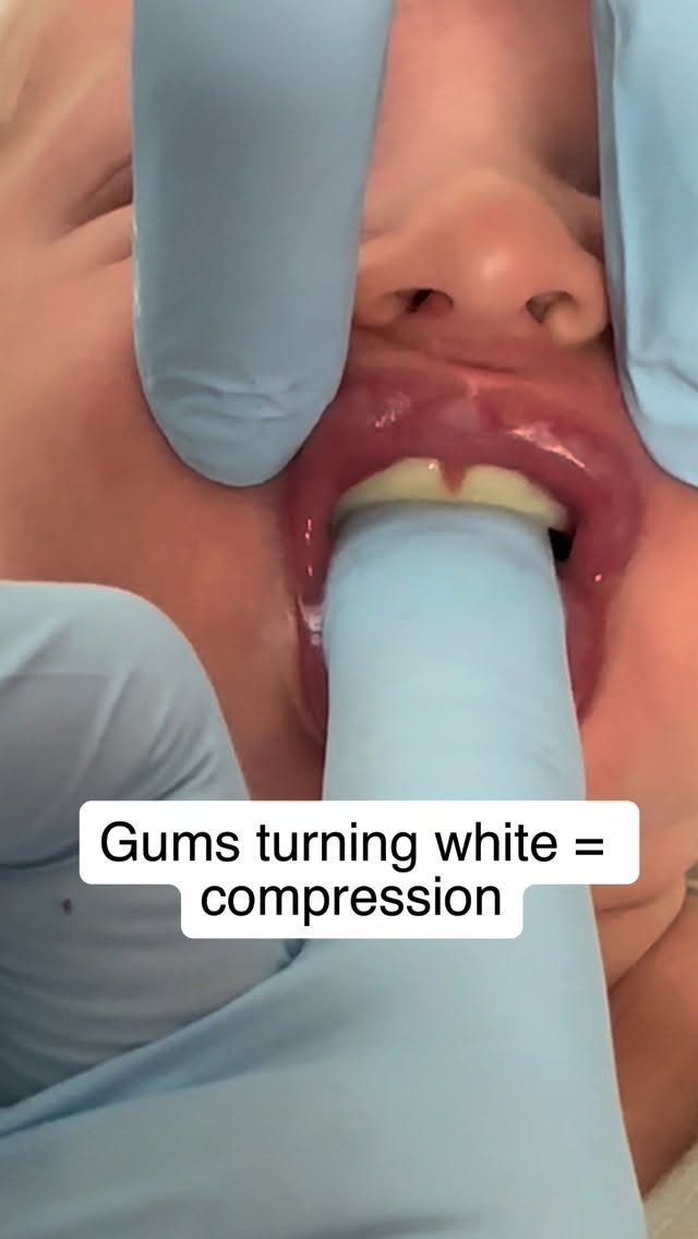 If feeding hurts… there’s always a reason. What you’re seeing here is blanching of the gums—a tempor…