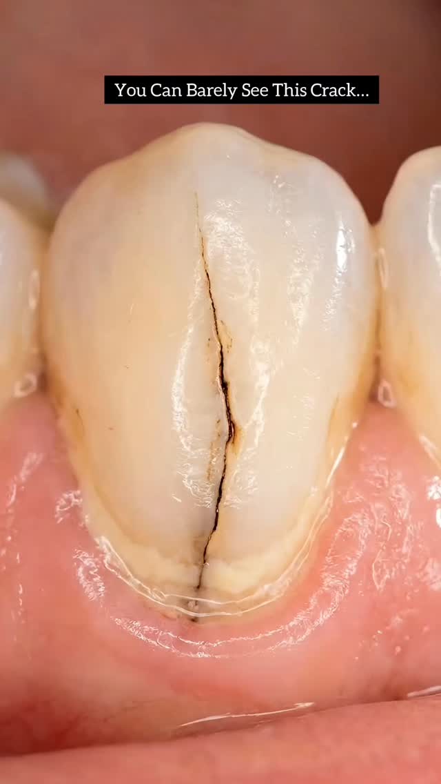 This Tiny Crack Is More Dangerous Than You Think 😳 #toothfix #toothcrack #teethcare #stisfying