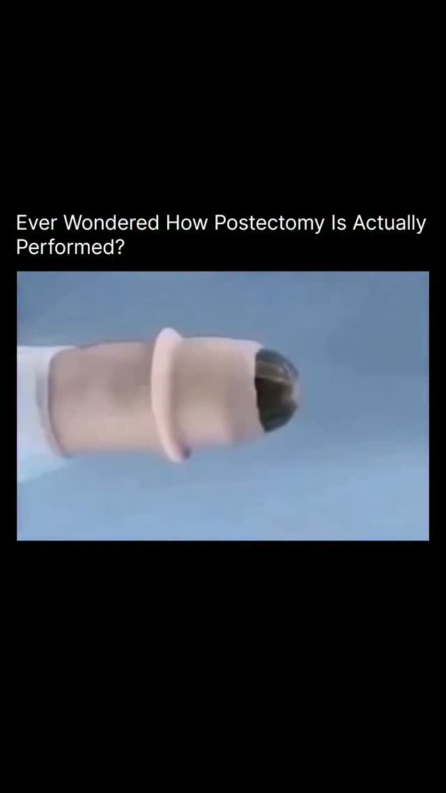 A postectomy, commonly known as circumcision, is a minor surgical procedure in which the foreskin co…