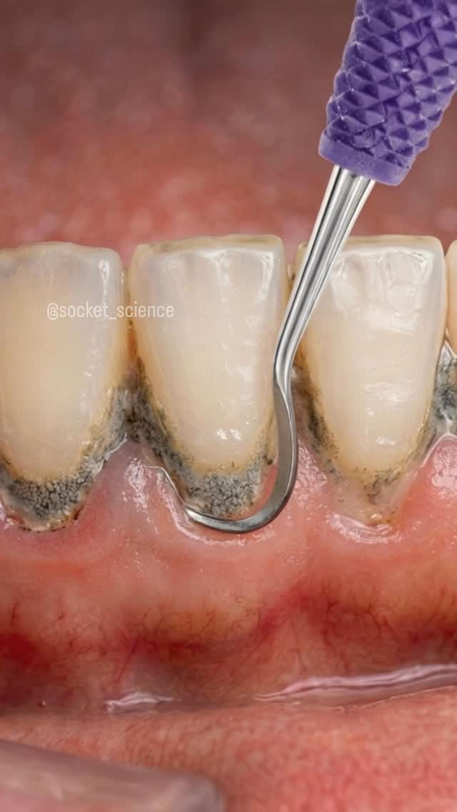 The Art of Debridement: Breaking the Calculus Bridge 🦷✨ What you’re seeing is the mechanical removal…