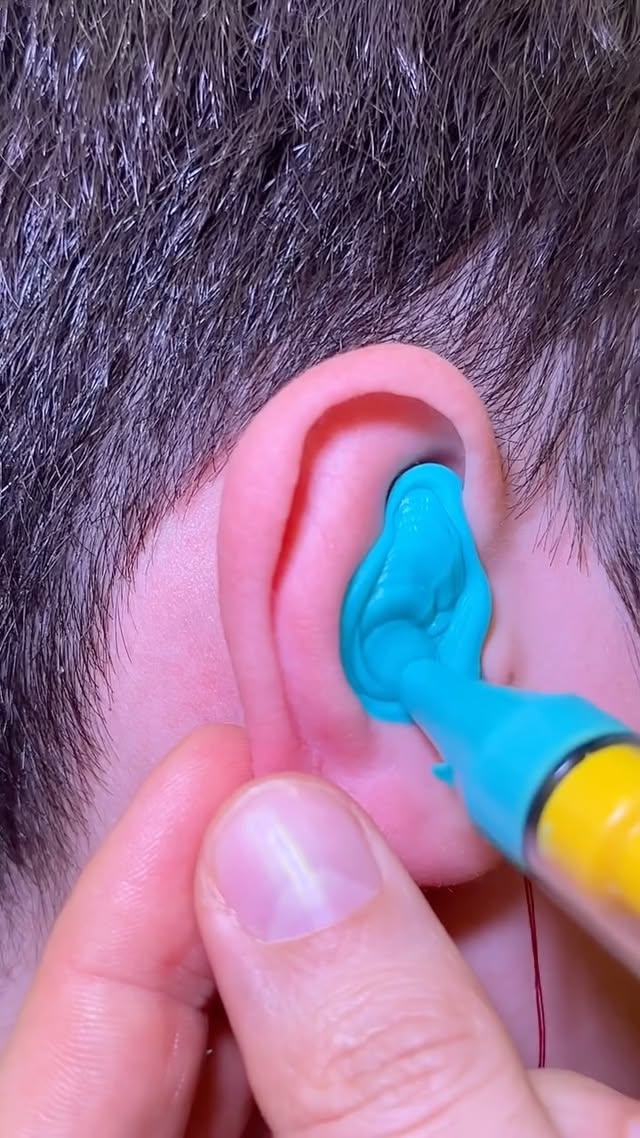 Today we took an ear impression from our little patient to prepare a custom hearing device. Ear impr…