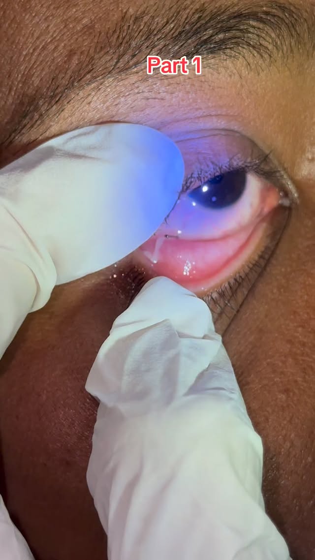 #OphthalmicAssistant #higlightsシ゚ #viralvideoシfyp #foryoupageシforyou #tendingvideos #dutytime #Ophth…