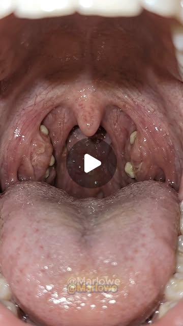 Keep your teeth clean for a healthy body. . . #ASMR #CalculusRemoval #TeethCleaning #ScalingTeeth #P…